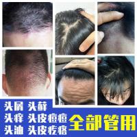 去屑止痒洗发水去屑毛囊焱防脱发控油洗发液头皮屑头痒洗头膏