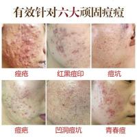 []草本祛痘精华液 祛痘去痘印闭口粉刺青春痘 积雪草祛痘精华液