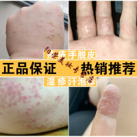 汗疱疹外用湿疹皮肤专用止痒去根膏过敏皮肤瘙痒汗疱疹水泡外用股癣