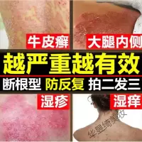 手脚的牛皮专用慢性顽固手癣水泡湿疹真菌感染止痒去根牛皮手藓膏
