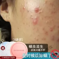 脸上去螨虫洗脸皂去螨虫去粉刺黑头脸上螨虫虫皂李佳琪脸部清洁祛痘 其他