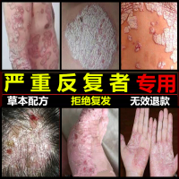 本剂癣苗医药糕膏外用止痒癣痒净狼毒藓痒灵非紫椒癣丁酊