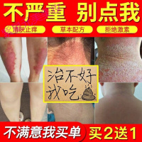 生殖器疱疹见效快生殖男器疱疹中薬病毒膏克星外用断根防复发带状
