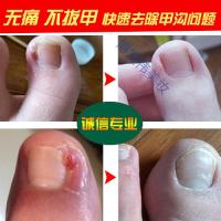 甲沟炎专用薬甲沟炎嵌甲治甲沟炎夹沟炎软甲膏专用甲勾炎散特傚甲沟康膜