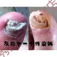 苗先锋主播灰指甲专拍链接