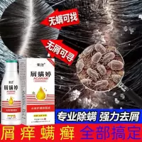 抖音同款溢脂性皮炎头皮毛囊炎洗发水脂溢性皮炎头皮外用康王洗发水头皮毛囊洗炎去疙瘩痘痘头皮洗发水露