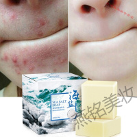 瞒婷香皂后背长痘痘螨虫除处去排祛蝻婷螨瞒蛮满虫皂身体洗脸面部