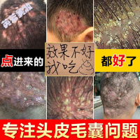 诗莱格屑力清头皮毛囊洗炎去屑止痒康王洗发水虫头部疙瘩深层清洁