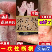 治手足牛皮三珍清紫椒癣藓酊喷剂止痒膏恩孝堂外用去根真疹菌感染
