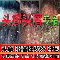 毛囊炎洗发水头痒头皮头发专用护理毛囊洗炎虫去满清洁去屑止痒洗发水