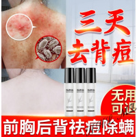 祛痘喷雾背部祛痘印粉刺去后背虫背上身上长痘痘胸前喷雾美背背后海源