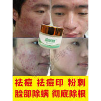 逗丽婷 祛痘去除闭口粉刺痘印脸部痘痘膏脸上螨虫面部男女学生神申器李佳琦
