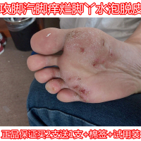 皮康王脚汽膏本乳膏止痒百痒宁乳膏烂脚丫脚痒膏