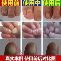 小林制药灰指甲抑液喷雾伊曲康挫浓缩冰醋酸印度