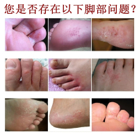 乳膏本脚臭汗瘙痒止痒脱皮烂脚丫开裂真菌滋润足藓