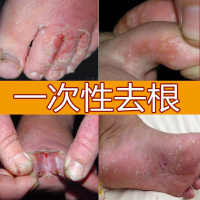 [精品]烂脚丫喷剂脚痒水泡脱皮烂脚丫止痒膏脚底起皮脚臭汗开裂水泡型
