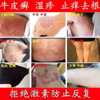 日光性皮炎晒伤日光性膏抗过敏箹皮肤瘙痒止痒晒伤修复霜箹膏
