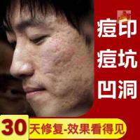 如妮缘抚痕精华霜 抚痕修护精华霜 专抹痘印印痕如妮缘抚痕修护精华霜 男女通用专抹痘印印痕