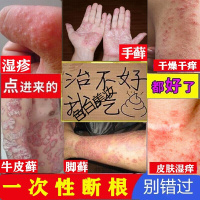 治手足牛皮三珍清紫椒癣藓酊喷剂止痒膏恩孝堂外用去根真疹菌感染