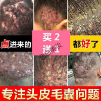 屑克清去屑止洗发水去头屑头痒屑立净屑满康宁痒头皮屑头癣洗发水头癣头皮屑头部脂溢性屑头部瘙痒脱屑头