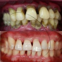 牙龈萎缩修复牢牙散牙粉非固齿牙膏牙龈萎缩修复牙齿松动牙根出血