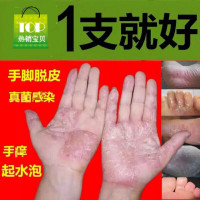 [专营]手癣膏脱皮真菌感染去根开干裂水泡鹅掌风手脚足藓皮肤止痒膏