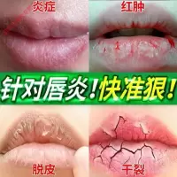 牧安宁唇康灵口唇炎口唇新款炎唇膏修复yao用软膏嘴唇干裂脱皮起皮上火起泡爛嘴角油YXN
