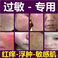 日光性皮肤炎膏修复脸部皮肤止痒膏脸上紫外线过敏专用日光性皮肤炎脂溢性面部