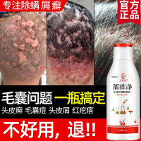 头发疏通毛囊堵塞毛囊炎洗发水头皮毛囊炎头痒治头皮毛囊炎洗发水露去头屑止痒控油虫专用头痒