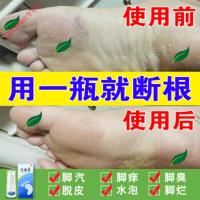 欧臣ochen小白瓶速皮肤膏济记喷剂脚臭止痒脱皮欧辰