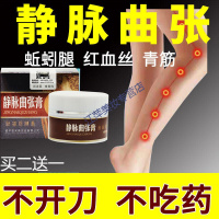 舒静通静脉曲张外用迈之灵精索静脉曲张的平小腿部曲宁舒静通中