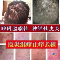 寻麻疹薬膏寻麻疹薬膏专治荨麻疹过敏止痒断根丘疹胆碱性人工划痕风团皮肤瘙痒外用薬膏