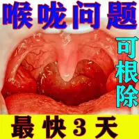 滤泡增生喉咙疼痛有痰干咳异物感滤泡增生咽喉肿胀扁桃体肿大发痒干呕贴
