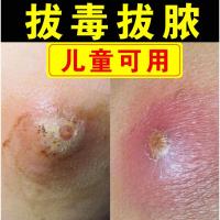 火疖子拔毒贴 火疖子 坐板疮 疖子 拔脓吸脓贴膏