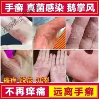 多芬爱治手脱皮手指季节性手上起皮起小水泡手痒水泡脱皮干裂手气止痒膏