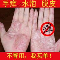 草本配方手痒脱皮水泡干裂手气膏手起小水泡止痒膏手干燥季节性反复成人