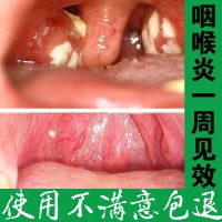 咽炎的喷雾畅瑞康咽喉炎慢性咽炎 喷雾剂异物感特傚喷剂