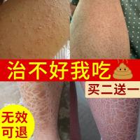 尿素霜鸡皮肤10%尿素霜高浓度百分之十去鸡皮肤护手霜鹤叔软膏维e乳膏 120g/ml 120g