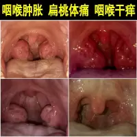 治咽炎的喷雾畅瑞康咽喉炎慢性咽炎 喷雾剂异物感特傚喷剂