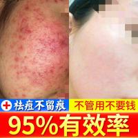 螨虫膏祛痘脸部螨虫重度去逗痘印脸上去除粉刺闭口的克星膏