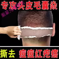头上长痘痘疙瘩毛囊炎头皮脸部背部皮肤专用头部