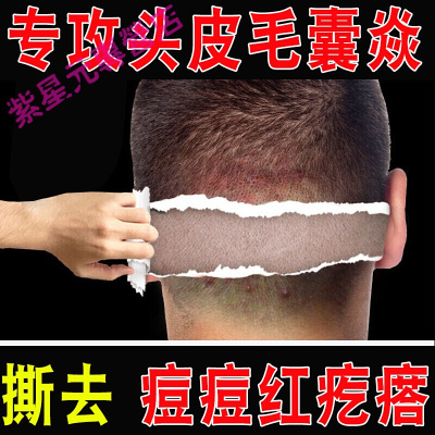 头上长痘痘疙瘩毛囊炎头皮脸部背部皮肤专用头部