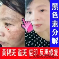 熊果苷乳膏退黑色素变白分解黑色素沉着皮秒后修复sod熊果甙 氢醌霜软膏乳霜同效