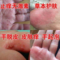 玉裂康乳膏汗孢疹脚痒手上长起小水泡百草止痒膏汗性红斑疱湿除根