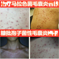 马拉色菌毛囊炎背上去手臂前胸后背头皮毛囊炎马拉色菌腿部皮囊炎专用膏