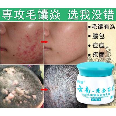 毛囊炎膏治毛囊炎头皮癣专用膏背部私处脸部头部祛痘真菌感染止痒膏