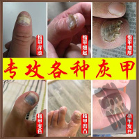 灰指甲液去软甲增厚甲沟炎专用灰指甲男女夫洁美宝 健康灰指甲众红鸿甲