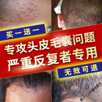 头皮痒毛囊炎洗发水痘痘发红疙瘩去螨虫去屑止痒控油去螨虫屑癣头痒头屑神s器 110mL