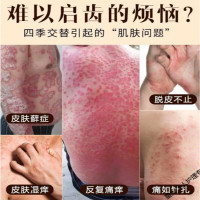 手足藓湿痒顽固牛皮肤藓大腿内侧囊肛周湿痒草本止痒足股体藓皮肤瘙痒外用乳膏