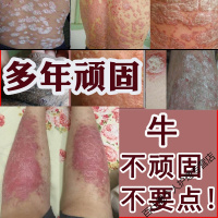 紫椒七草套装癣酊外用喷剂软膏花斑癣手足藓体股藓湿疹牛皮止痒薬膏